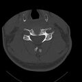 Occipital condyle fracture (Radiopaedia 31755-32691 Axial bone window 46).jpg