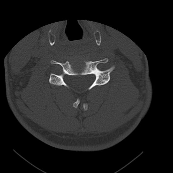 File:Occipital condyle fracture (Radiopaedia 31755-32691 Axial bone window 46).jpg