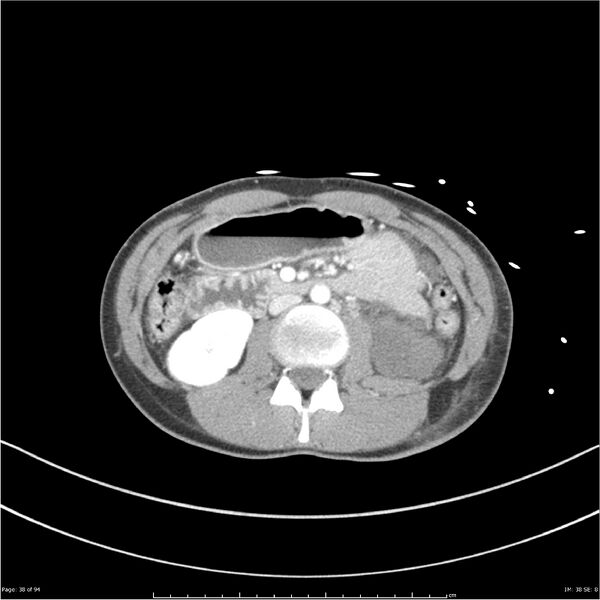 File:Traumatic renal artery dissection and pancreatic transection (Radiopaedia 37061-38739 Axial 227).jpg