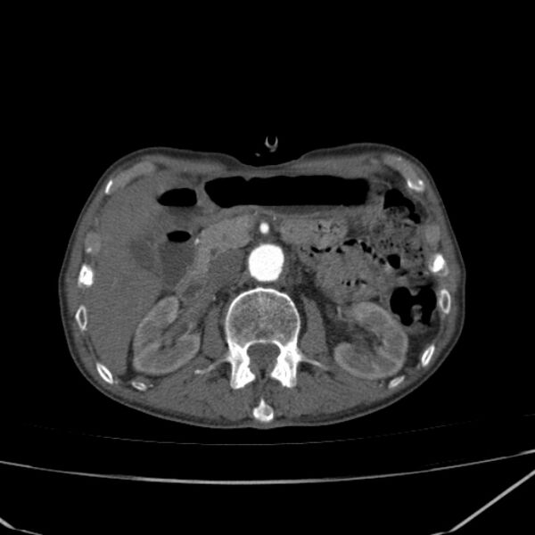 File:Abdominal aortic aneurysm (Radiopaedia 23703-23856 Axial C+ arterial phase 26).jpg