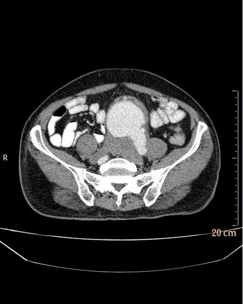 File:Abdominal aortic aneurysm (Radiopaedia 25985-26121 Axial C+ arterial phase 29).jpg