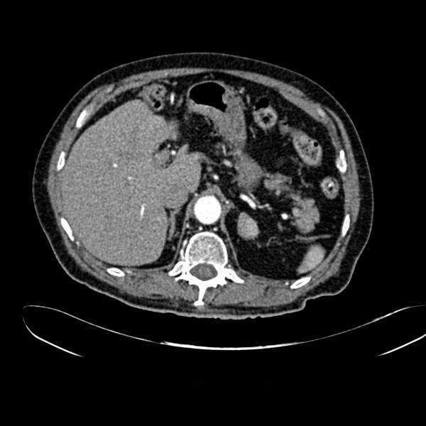 File:Abdominal aortic aneurysm (Radiopaedia 75131-86203 Axial C+ arterial phase 12).jpg