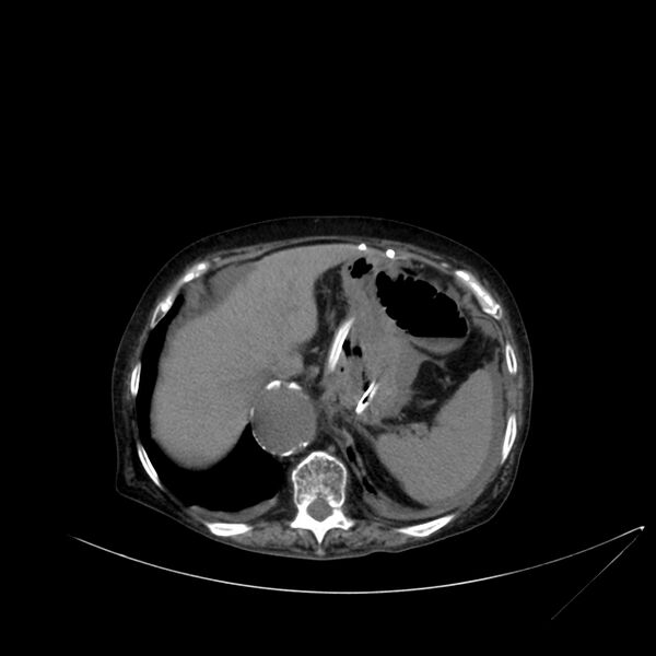 File:Abdominal aortic aneurysm - impending rupture (Radiopaedia 19233-19246 Axial non-contrast 27).jpg