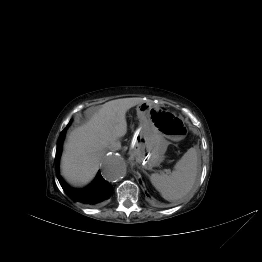Abdominal aortic aneurysm - impending rupture (Radiopaedia 19233-19246 Axial non-contrast 27).jpg