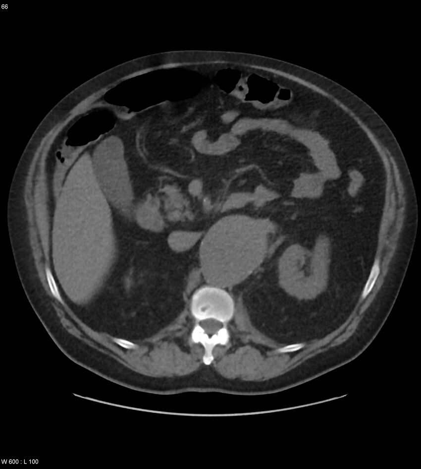 Abdominal aortic aneurysm with intramural hematoma then rupture (Radiopaedia 50278-55631 Axial non-contrast 62).jpg