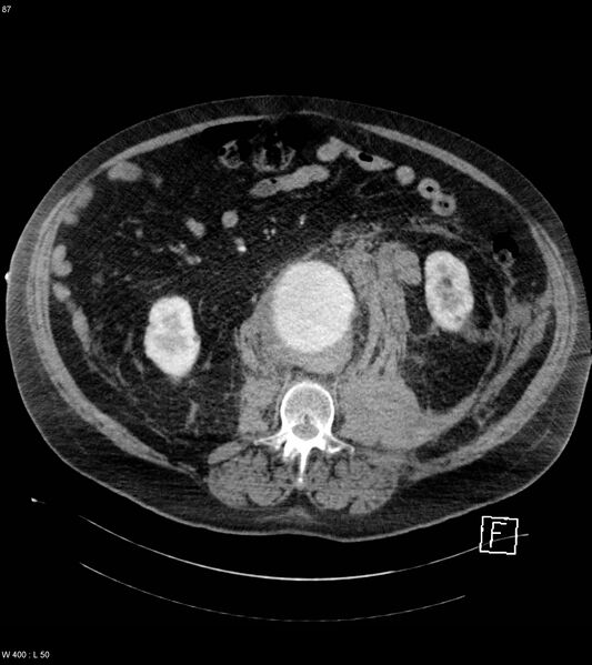 File:Abdominal aortic aneurysm with intramural hematoma then rupture (Radiopaedia 50278-55632 Axial C+ arterial phase 86).jpg