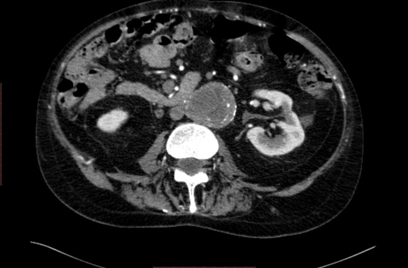 File:Abdominal aortic interposition tube graft and aneurysm thrombosis (Radiopaedia 71438-81857 Axial C+ arterial phase 77).jpg