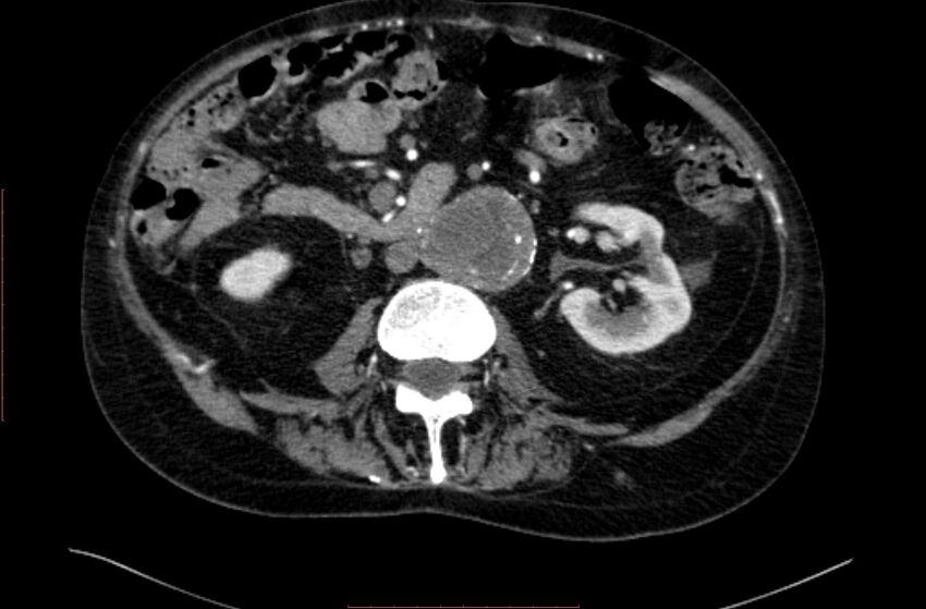 Abdominal aortic interposition tube graft and aneurysm thrombosis (Radiopaedia 71438-81857 Axial C+ arterial phase 77).jpg
