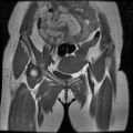Abdominal wall endometriosis (Radiopaedia 83702-98847 Coronal T1 4).jpg