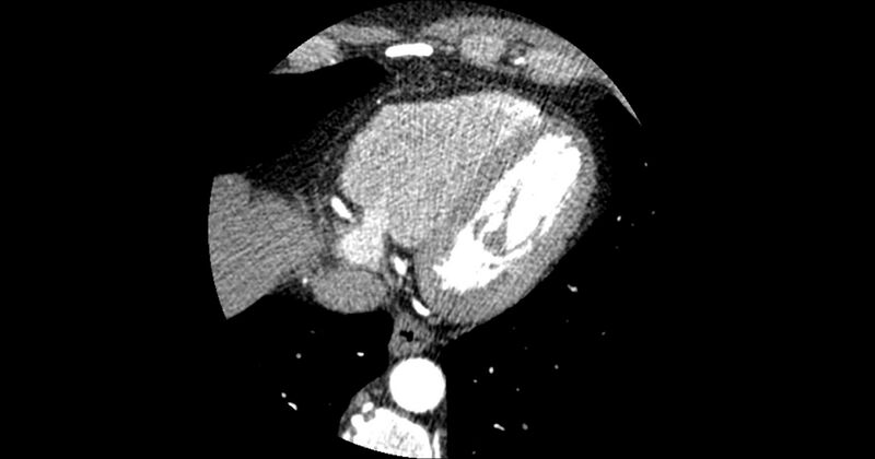 File:Aberrant left main coronary artery (ALMCA) arising from the right sinus with interarterial course (Radiopaedia 63251-71814 Axial C+ arterial phase 160).JPG