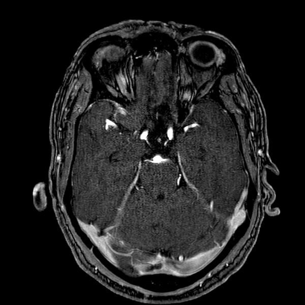 File:Accessory middle cerebral artery (Radiopaedia 73114-83828 Axial MRA 63).jpg