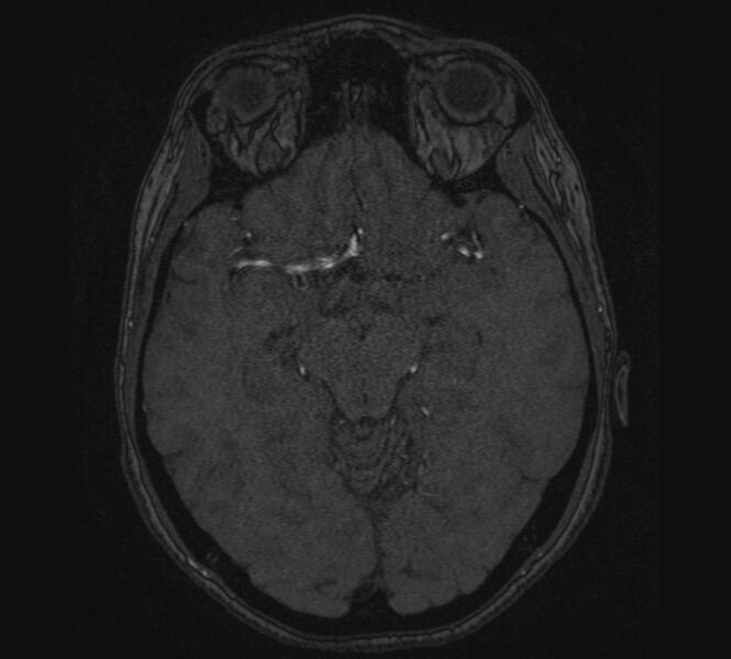File:Accessory middle cerebral artery and ICA aneurysm (Radiopaedia 22656-22674 MRA 54).jpg