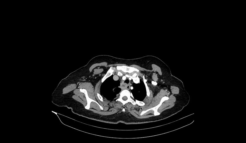 File:Acquired tracheo-esophageal fistula (Radiopaedia 51356-57103 Axial C+ arterial phase 20).jpg