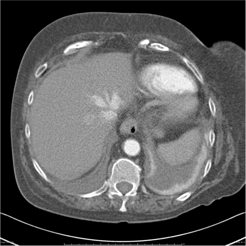 Acute-on-chronic pulmonary emboli (Radiopaedia 27925-28169 C+ CTPA 69).jpg