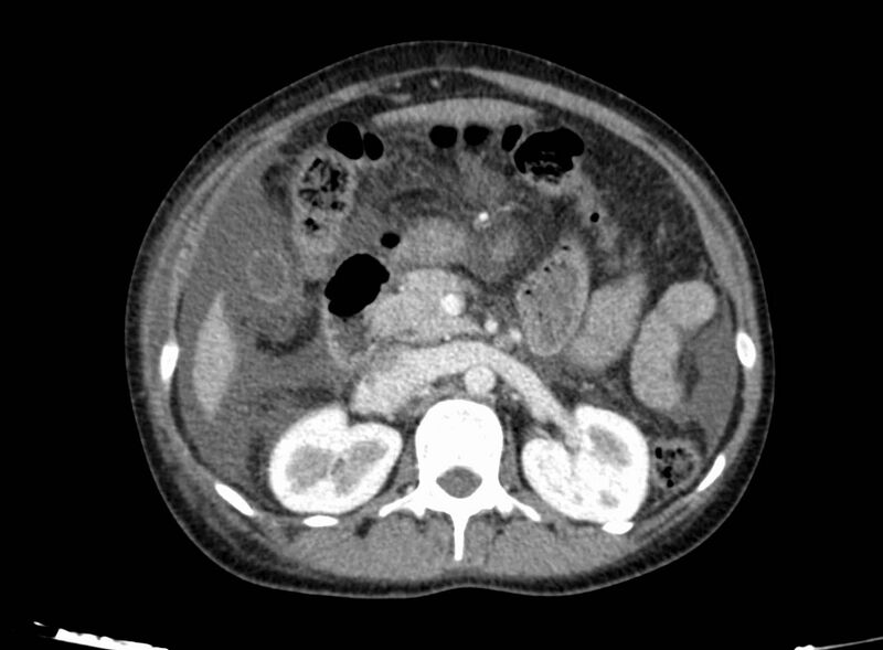 File:Acute Budd-Chiari syndrome (Radiopaedia 60858-68638 Axial C+ portal venous phase 119).jpg