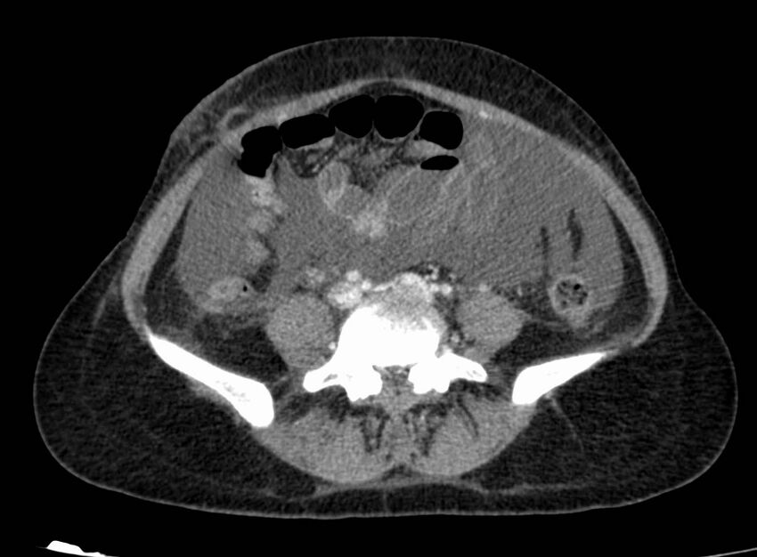 Acute Budd-Chiari syndrome (Radiopaedia 60858-68638 Axial C+ portal venous phase 202).jpg