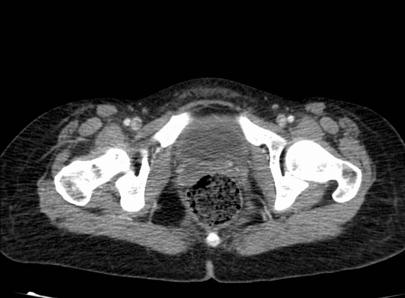 File:Acute Budd-Chiari syndrome (Radiopaedia 60858-68638 Axial C+ portal venous phase 294).jpg