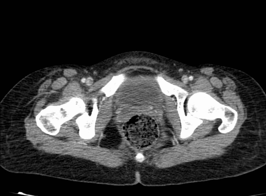 Acute Budd-Chiari syndrome (Radiopaedia 60858-68638 Axial C+ portal venous phase 294).jpg
