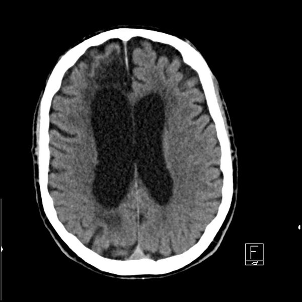 File:Acute ICA ischemic penumbra due to high-grade CCA stenosis (CT perfusion) (Radiopaedia 72038-82529 Axial non-contrast 30).jpg