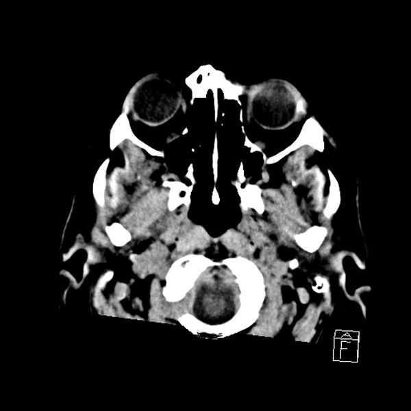 File:Acute P1 occlusion with PCA ischemia penumbra (CT perfusion) (Radiopaedia 72084-82586 Axial non-contrast 1).jpg