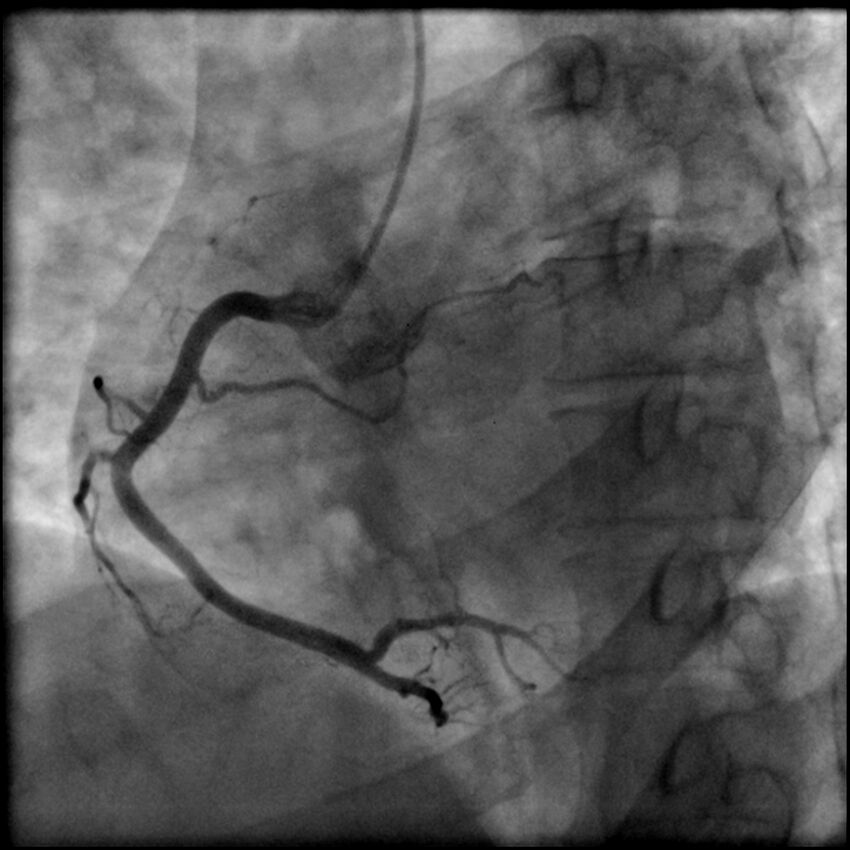 Acute anteroseptal myocardial infarction (Radiopaedia 68409-77946 RAO straight RCA 25).jpg