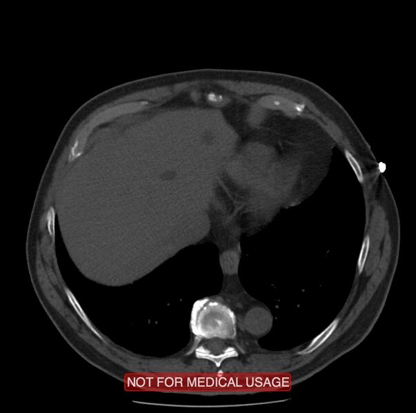 File:Acute aortic dissection - Stanford type A (Radiopaedia 40661-43285 Axial non-contrast 56).jpg