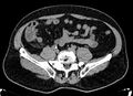Acute appendicitis (Radiopaedia 13030-13091 Axial non-contrast 14).jpg