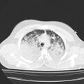 Acute aspiration pneumonitis (Radiopaedia 33605-34703 Axial lung window 30).jpg