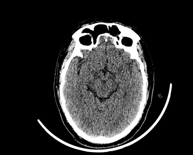 File:Acute cerebral infarct (Radiopaedia 35604-37123 Axial non-contrast 42).jpg