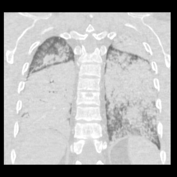 File:Acute diffuse alveolar hemorrhage (Radiopaedia 41323-44158 Coronal lung window 45).jpg