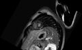 Acute myocarditis (Radiopaedia 77023-88967 Short axis stack LGE 2).jpg