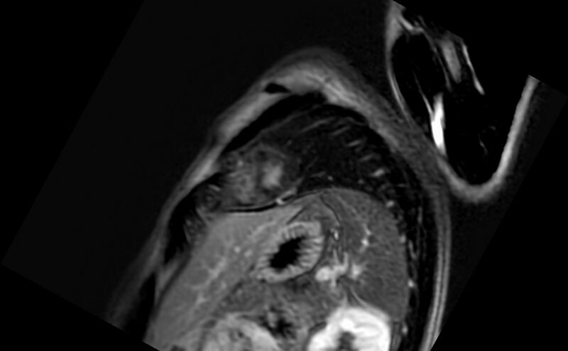 File:Acute myocarditis (Radiopaedia 77023-88967 Short axis stack LGE 2).jpg