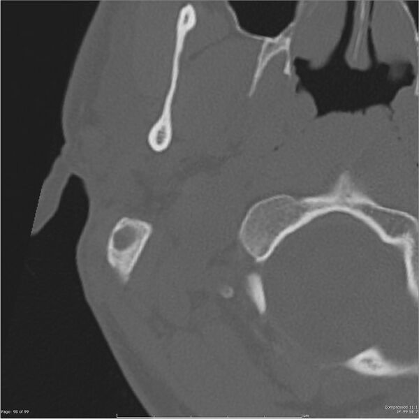 File:Acute otomastoiditis (Radiopaedia 28276-28512 Axial PTB bone window reformat 78).jpg