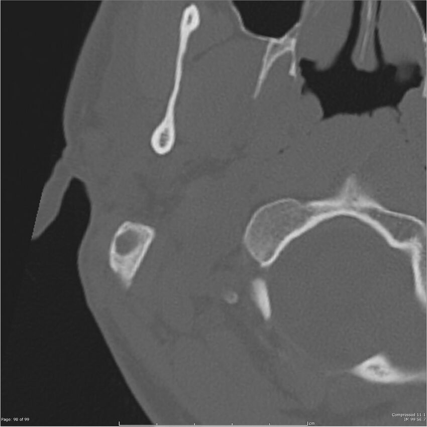 Acute otomastoiditis (Radiopaedia 28276-28512 Axial PTB bone window reformat 78).jpg