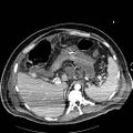 Acute pancreatic necrosis (Radiopaedia 13560-18502 Axial C+ portal venous phase 11).jpg