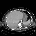 Acute pancreatic necrosis (Radiopaedia 13560-18503 Axial C+ portal venous phase 11).jpg