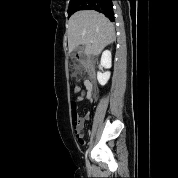 File:Acute pancreatitis (Radiopaedia 69236-79012 Sagittal C+ portal venous phase 67).jpg