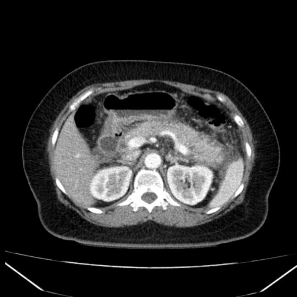 File:Acute pancreatitis - Balthazar C (Radiopaedia 26569-26714 Axial C+ arterial phase 29).jpg
