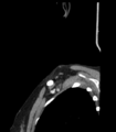 Acute parotitis (Radiopaedia 27425-27619 Sagittal C+ portal venous phase 56).png