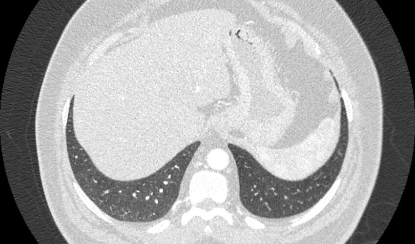 Acute pulmonary embolism with pulmonary infarcts (Radiopaedia 77688-89908 Axial lung window 116).jpg