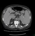 Acute renal failure post IV contrast injection- CT findings (Radiopaedia 47815-52559 Axial C+ portal venous phase 24).jpg