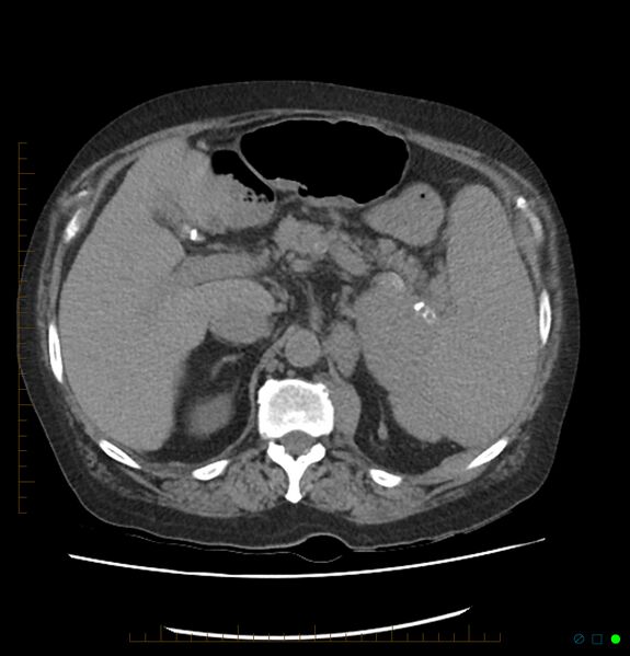 File:Acute renal failure post IV contrast injection- CT findings (Radiopaedia 47815-52559 Axial C+ portal venous phase 24).jpg