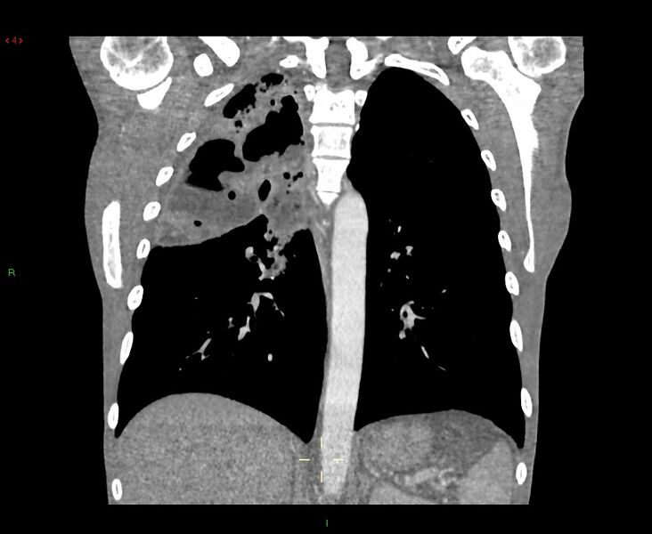 File:Acute right lung abscess (Radiopaedia 34806-36258 Coronal C+ arterial phase 19).jpg