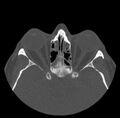 Acute sinusitis (Radiopaedia 23161-23215 Axial bone window 49).jpg