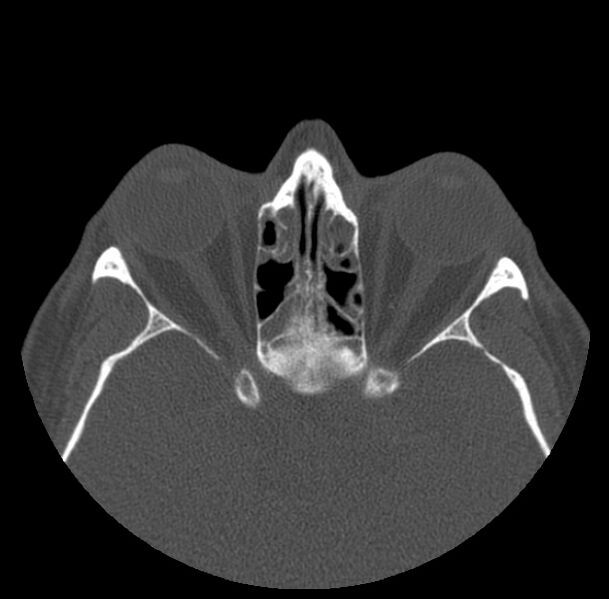 File:Acute sinusitis (Radiopaedia 23161-23215 Axial bone window 49).jpg