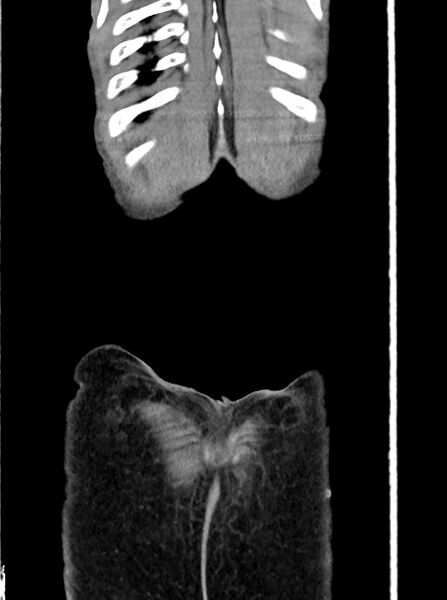 File:Acute small bowel (ileal) volvulus (Radiopaedia 71740-82139 Coronal C+ portal venous phase 109).jpg