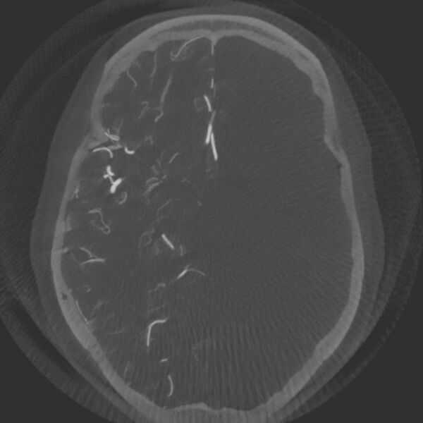 File:Acute subarachnoid hemorrhage and accessory anterior cerebral artery (Radiopaedia 69231-79010 Axial arterial - MIP 36).jpg