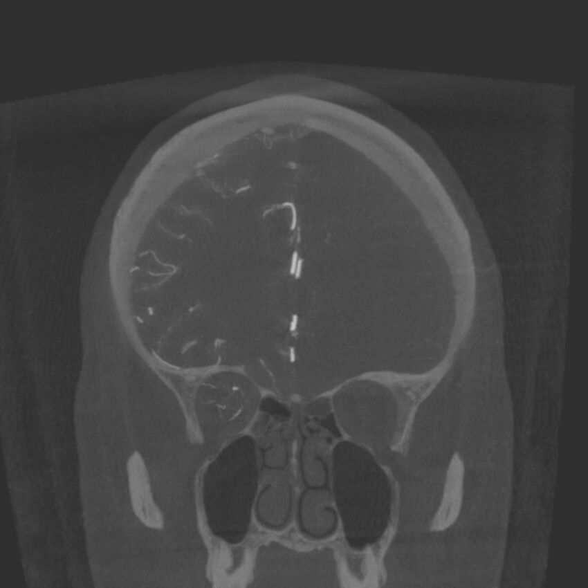 Acute subarachnoid hemorrhage and accessory anterior cerebral artery (Radiopaedia 69231-79010 Coronal arterial - MIP 27).jpg