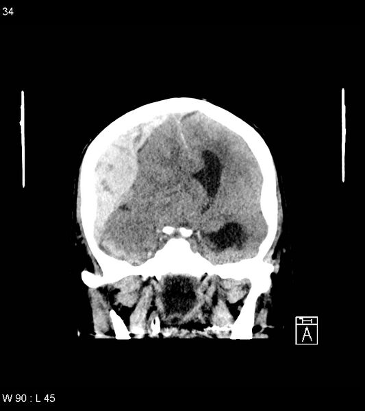 File:Acute subdural hematoma with myelofibrosis (Radiopaedia 52582-58494 Coronal non-contrast 25).jpg