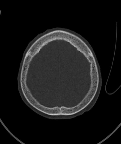 File:Acute traumatic subdural hematoma (Radiopaedia 82921-97257 Axial bone window 25).jpg